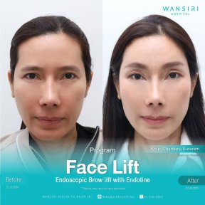 Avant/après lifting endoscopique des sourcils avec Endotine à Wansiri Hospital, résultat