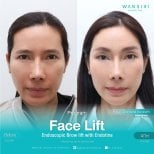 Avant/après lifting endoscopique des sourcils avec Endotine à Wansiri Hospital, résultat