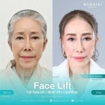 Résultats avant/après lifting visage, cou et lipofilling à Wansiri Hospital