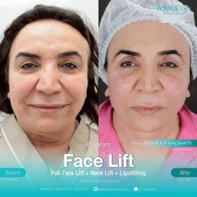Résultats avant et après lifting visage, cou et lipofilling à Wansiri Hospital