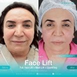 Résultats avant et après lifting visage, cou et lipofilling à Wansiri Hospital