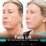 Résultats avant/après lifting visage, cou et platysmaplastie à Wansiri Hospital