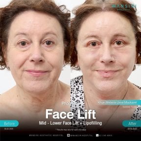 Avant-après lifting du visage avec lipofilling à Wansiri Hospital, rajeunissement visible