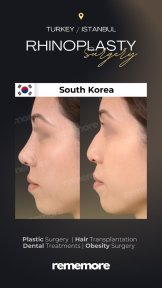نتائج قبل وبعد عملية تجميل الأنف التصحيحية في مستشفى ميموريال باهجيليفلر، إعادة تشكيل الأنف