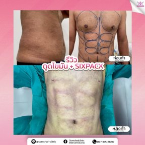 before-after photo liposakciya