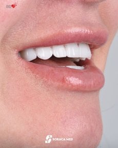 before-after photo dental-implant
