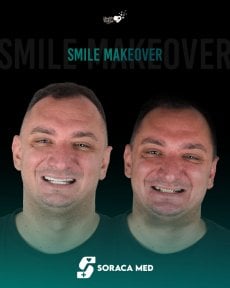before-after photo dental-implant