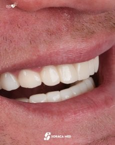 before-after photo dental-implant