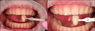 before-after photo tooth-whitening