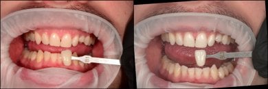 before-after photo tooth-whitening