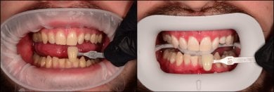 before-after photo tooth-whitening