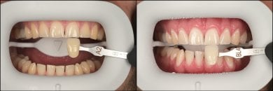 before-after photo tooth-whitening