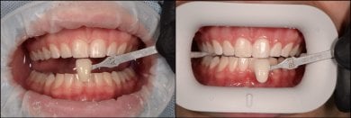 before-after photo tooth-whitening
