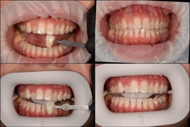 before-after photo tooth-whitening