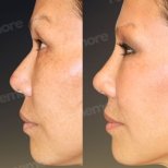 نتائج عملية تجميل الأنف قبل وبعد في مستشفى ميموريال بهجيليفلر، إعادة تشكيل الأنف