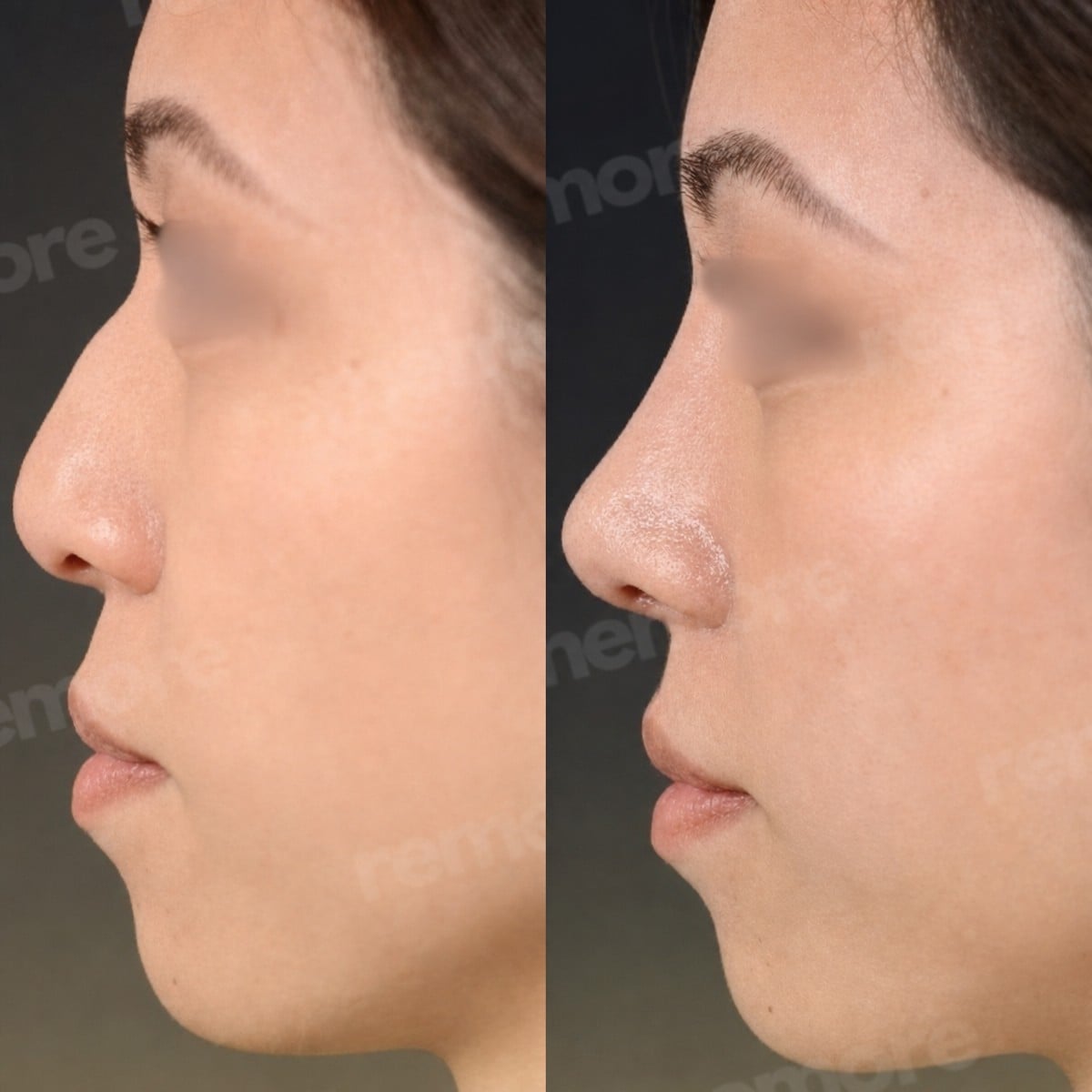 Resultados de rinoplastia antes y después en Memorial Bahçelievler Hospital, remodelación nasal