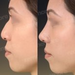 نتائج تجميل الأنف قبل وبعد في مستشفى ميموريال باهجيليفلر، إعادة تشكيل الأنف