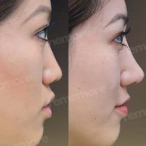 نتائج عملية تجميل الأنف قبل وبعد في مستشفى ميموريال بهجيليفلر، إعادة تشكيل الأنف