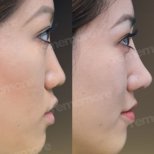 نتائج عملية تجميل الأنف قبل وبعد في مستشفى ميموريال بهجيليفلر، إعادة تشكيل الأنف