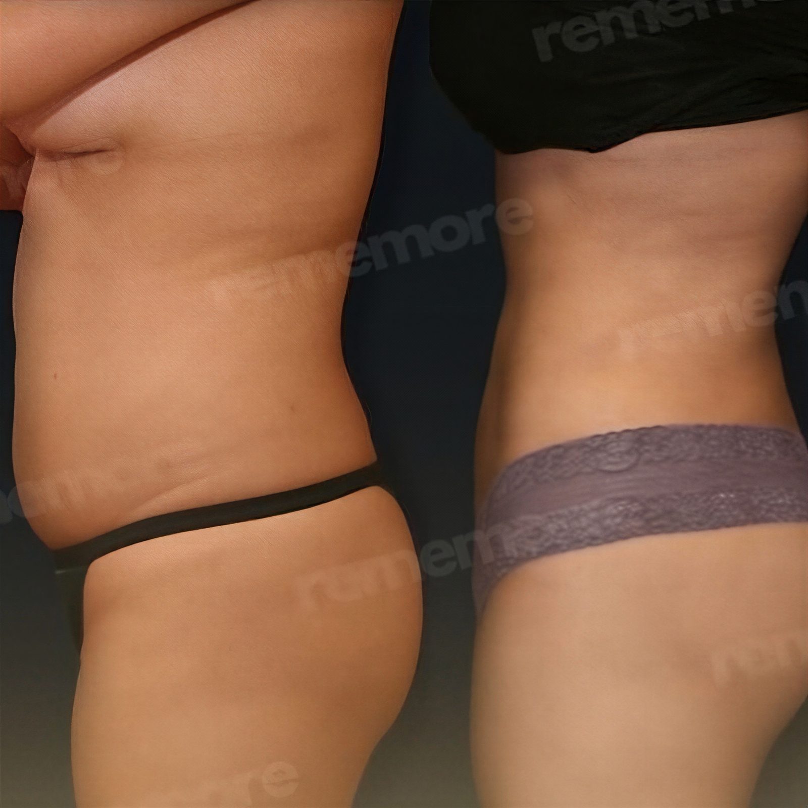 Resultados de liposucción abdominal antes y después en Memorial Antalya Hospital, cintura más delgada