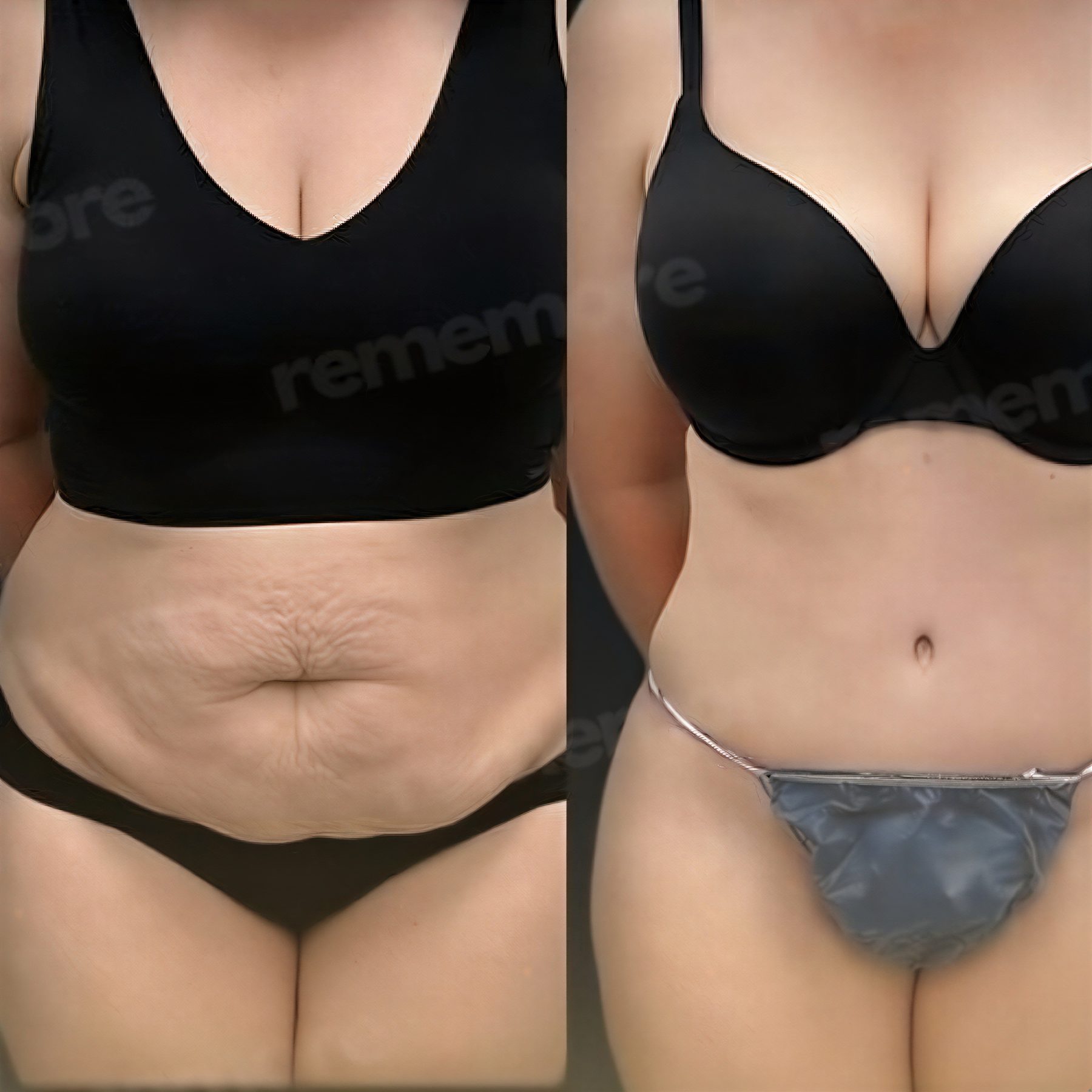 Resultados de liposucción abdominal antes y después en Memorial Antalya Hospital, abdomen plano