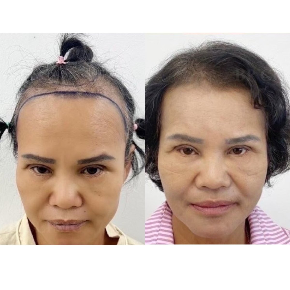 Resultados de trasplante capilar antes y después en Somchai Clinic, línea capilar restaurada