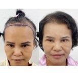 نتائج زراعة الشعر قبل وبعد في عيادة سومشاي، خط شعر مستعاد وشعر أكثر كثافة