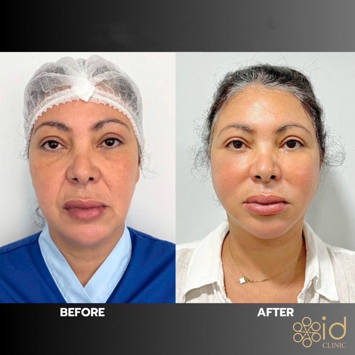 نتائج نقل دهون الوجه قبل وبعد في ID Clinic Bangkok، زيادة امتلاء الوجه