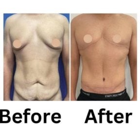 before-after photo abdominoplasty