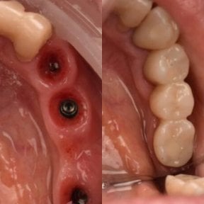 before-after photo dental-implant