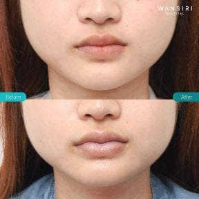 before-after photo lip-lift