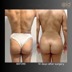 Resultados antes y después de Brazilian Butt Lift en ID Clinic Bangkok, 14 días tras cirugía