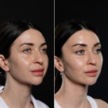 Efekty przed i po deep plane facelift w Vidnova Clinic – widoczne odmłodzenie twarzy