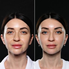 Efekty przed i po deep plane facelift w Vidnova Clinic – odmłodzenie twarzy