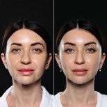 Efekty przed i po deep plane facelift w Vidnova Clinic – odmłodzenie twarzy