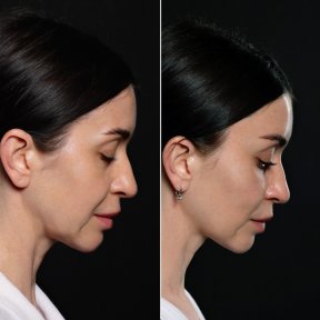 Efekty przed i po deep plane facelift w Vidnova Clinic – widoczne odmłodzenie twarzy