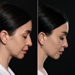 Efekty przed i po deep plane facelift w Vidnova Clinic – widoczne odmłodzenie twarzy