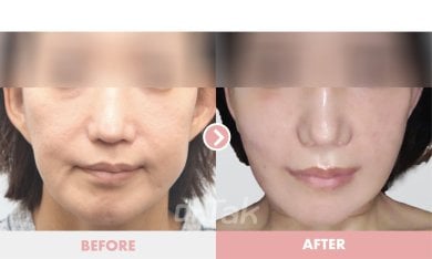 before-after photo deep-plane-facelift