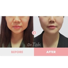 before-after photo deep-plane-facelift
