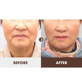 before-after photo deep-plane-facelift