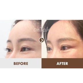 before-after photo lifting-lba