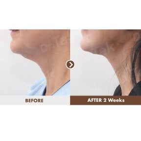 before-after photo neck-lift