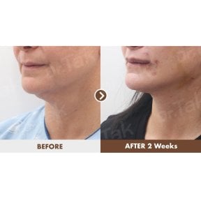 before-after photo neck-lift