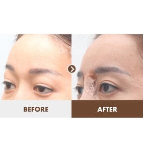 before-after photo lifting-lba