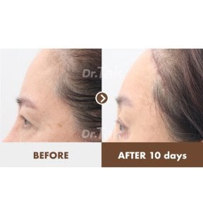 before-after photo lifting-lba