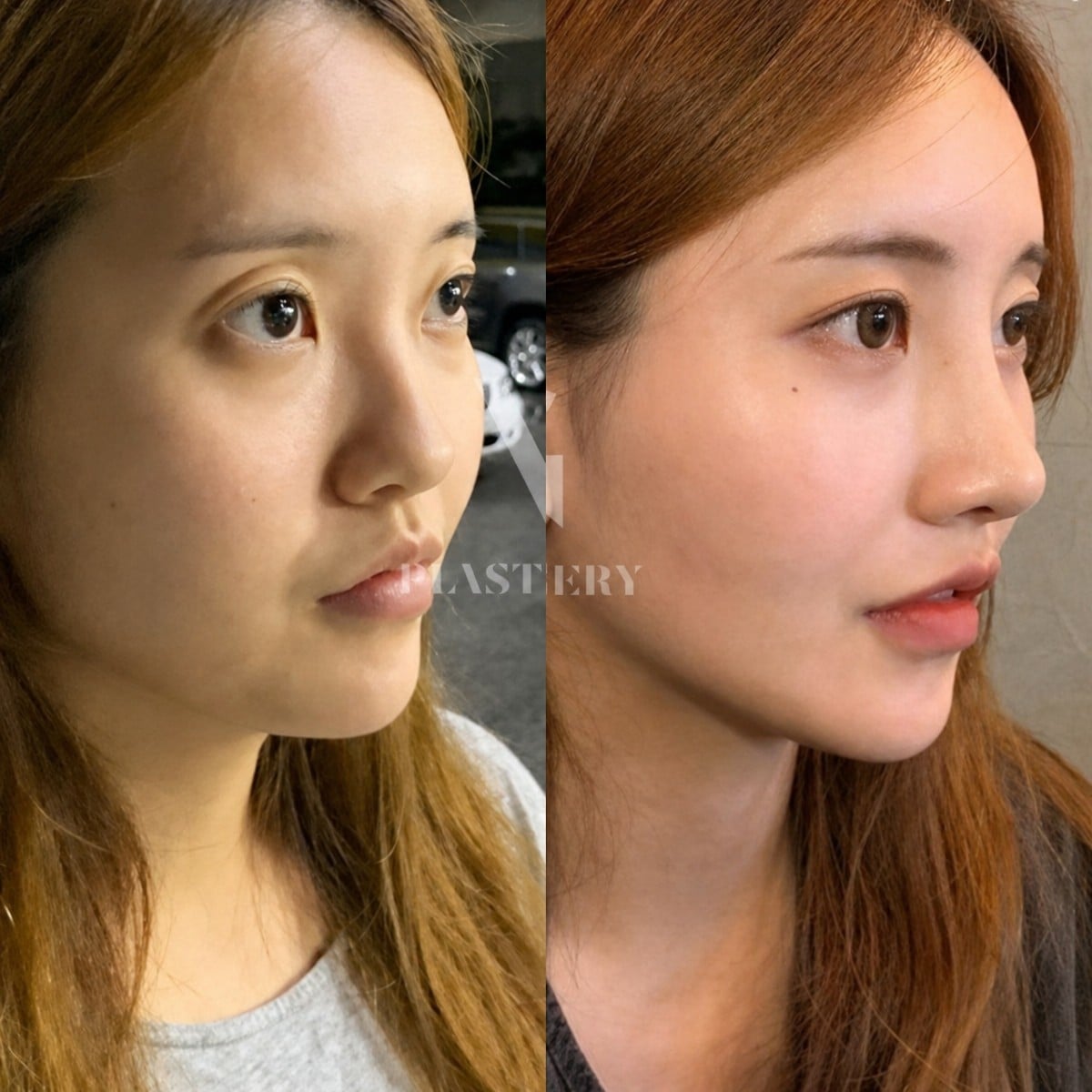 نتائج قبل وبعد عملية تجميل الأنف التصحيحية في VG Plastic Surgery، تحسين شكل الأنف