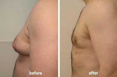 before-after photo liposuction