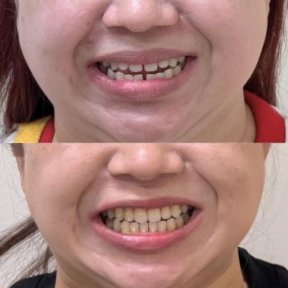 before-after photo invisalign