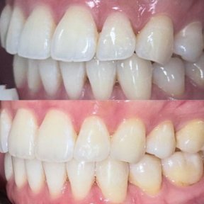 before-after photo invisalign