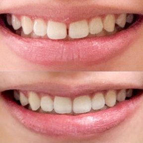 before-after photo invisalign